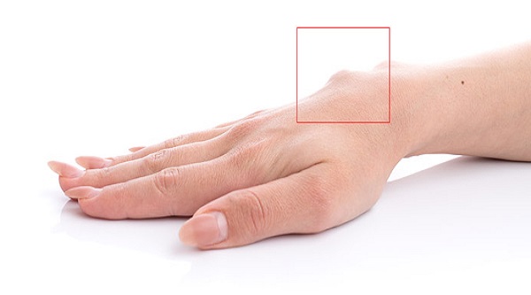 How To Get Rid Of Ganglion Cyst Naturally